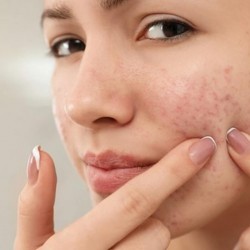 AKNE – SIMPTOMI I UZROCI