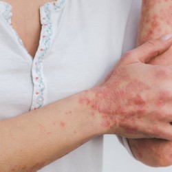 PSORIJAZA - UZROCI I LEČENJE